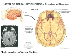 brain-injury