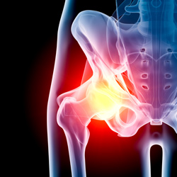 hip-implant-class-action