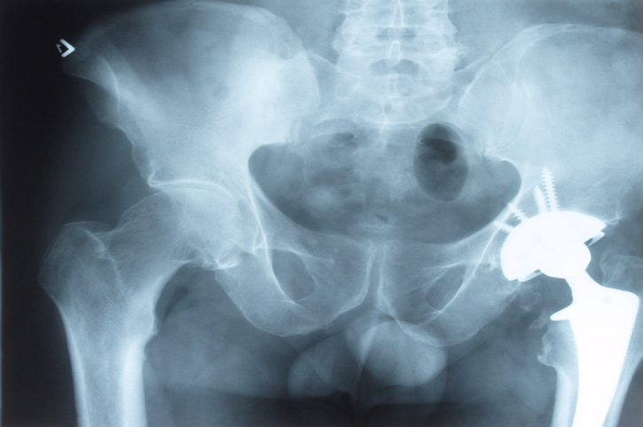 hip implant x-ray